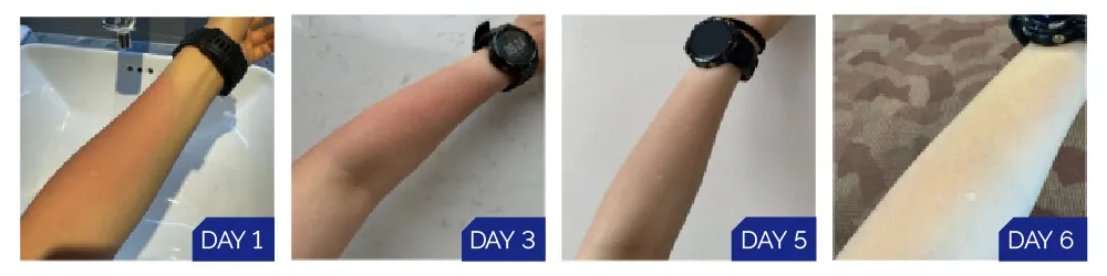 Sunburn recovery case study