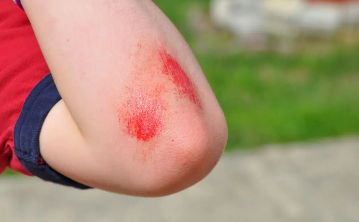 Abrasions (Scrapes)