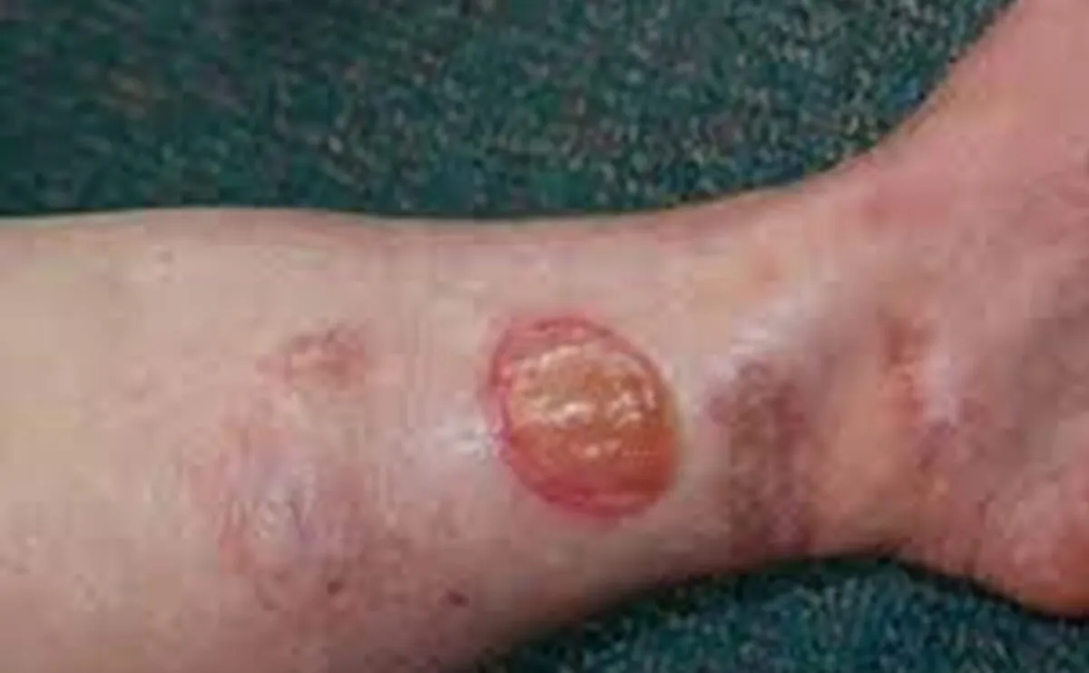 自身免疫性创面