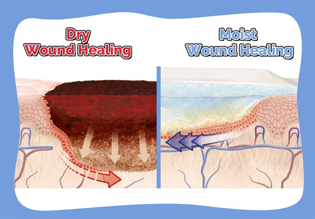 Comparison of Moist vs Dry Wound Healing