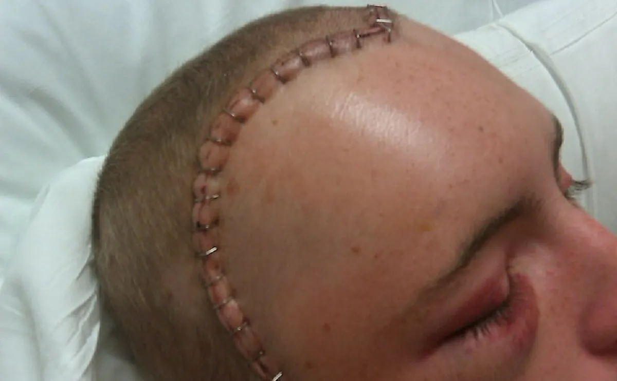 Craniotomy Wound