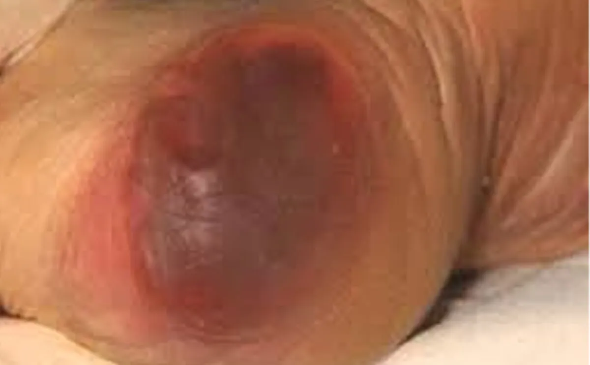 深部组织压力性损伤