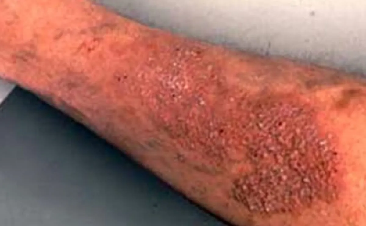 Neurally Derived Wounds