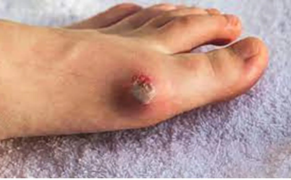 神经病变性溃疡