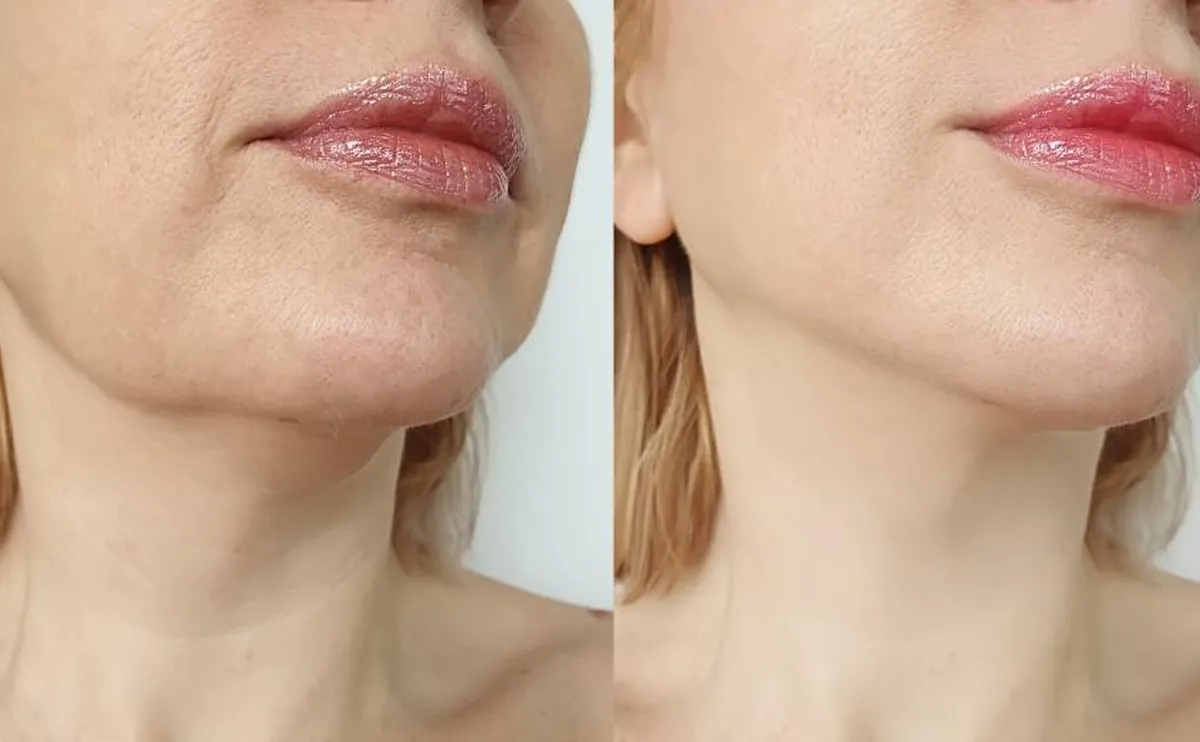 Non-Invasive Radiofrequency