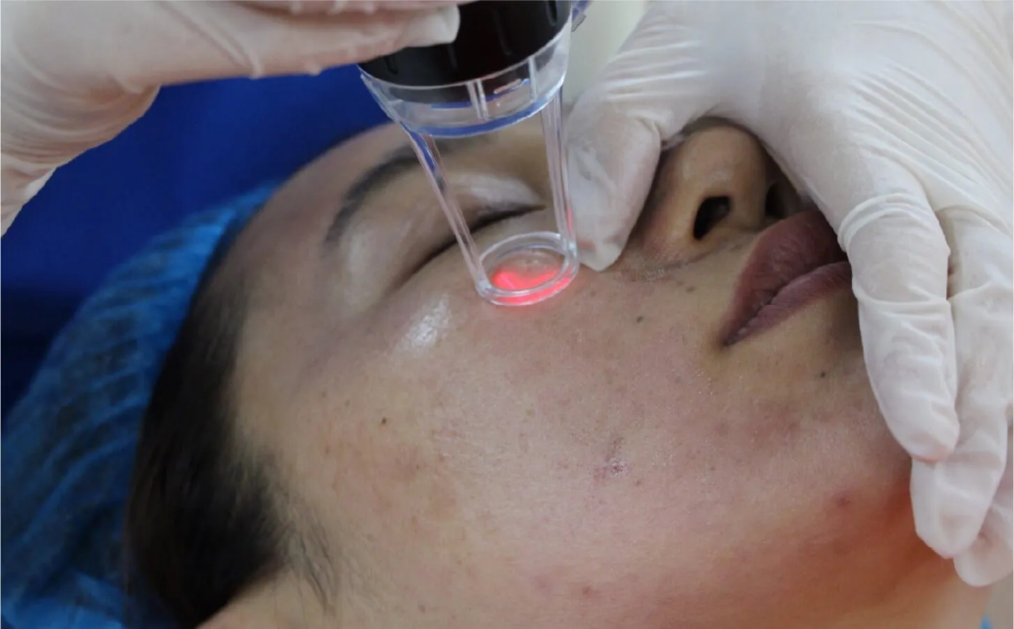 激光或微针术后