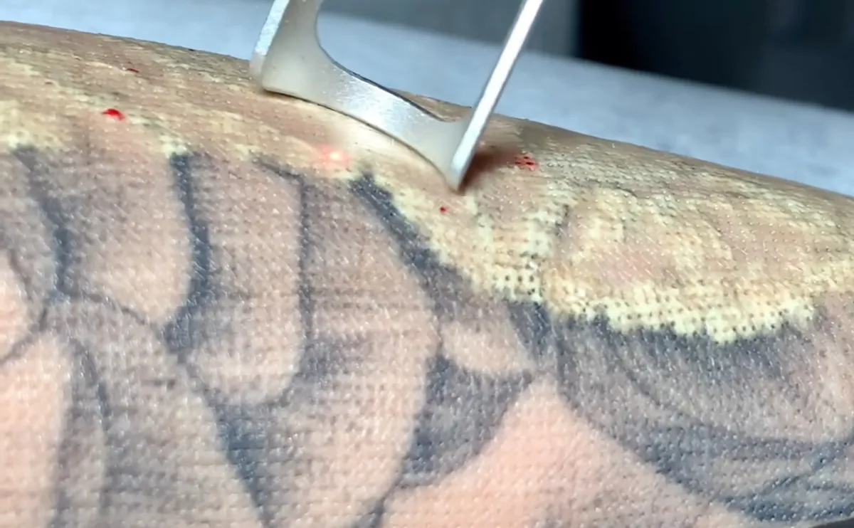 Tattoo Removal