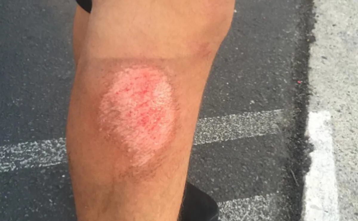 Turf Burns (Road Rash on Artificial Surfaces)