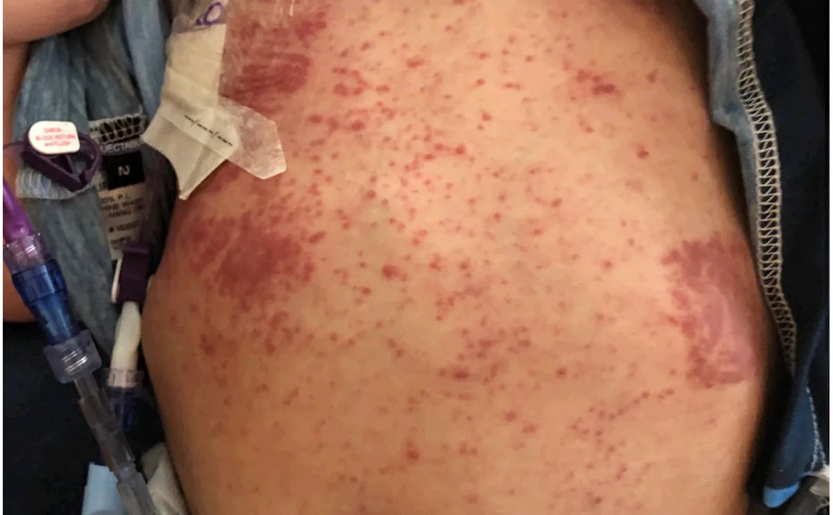 化疗或生物制剂相关创面