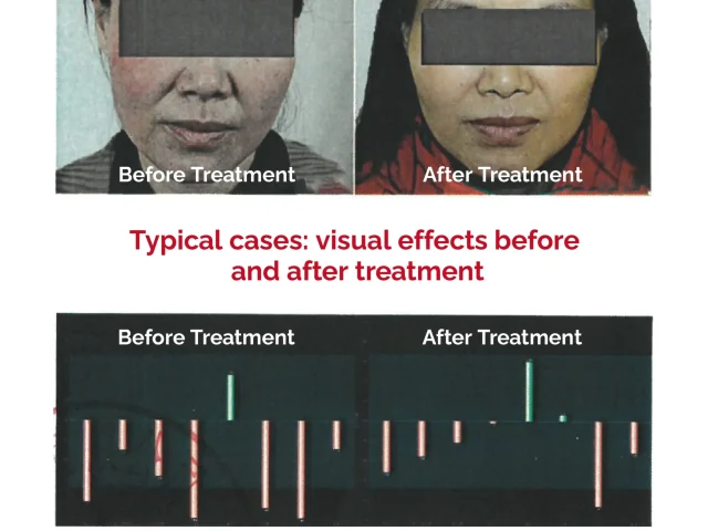 Comparison of VISIA before and after treatment