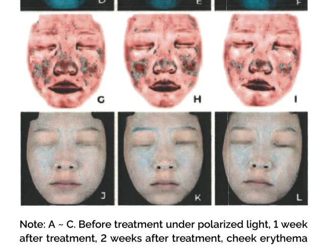 comparison of clinical efficacy between the two groups under white light and polarized light sources result 1
