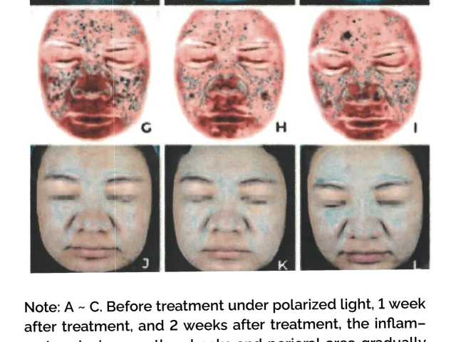 comparison of clinical efficacy between the two groups under white light and polarized light sources result 2